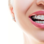 Aparat ortodontyczny - Ortodoncja