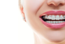 Aparat ortodontyczny - Ortodoncja